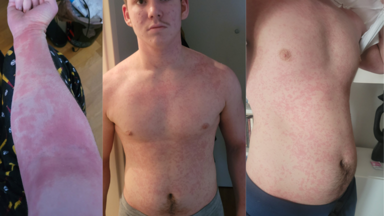 How I Healed My Eczema