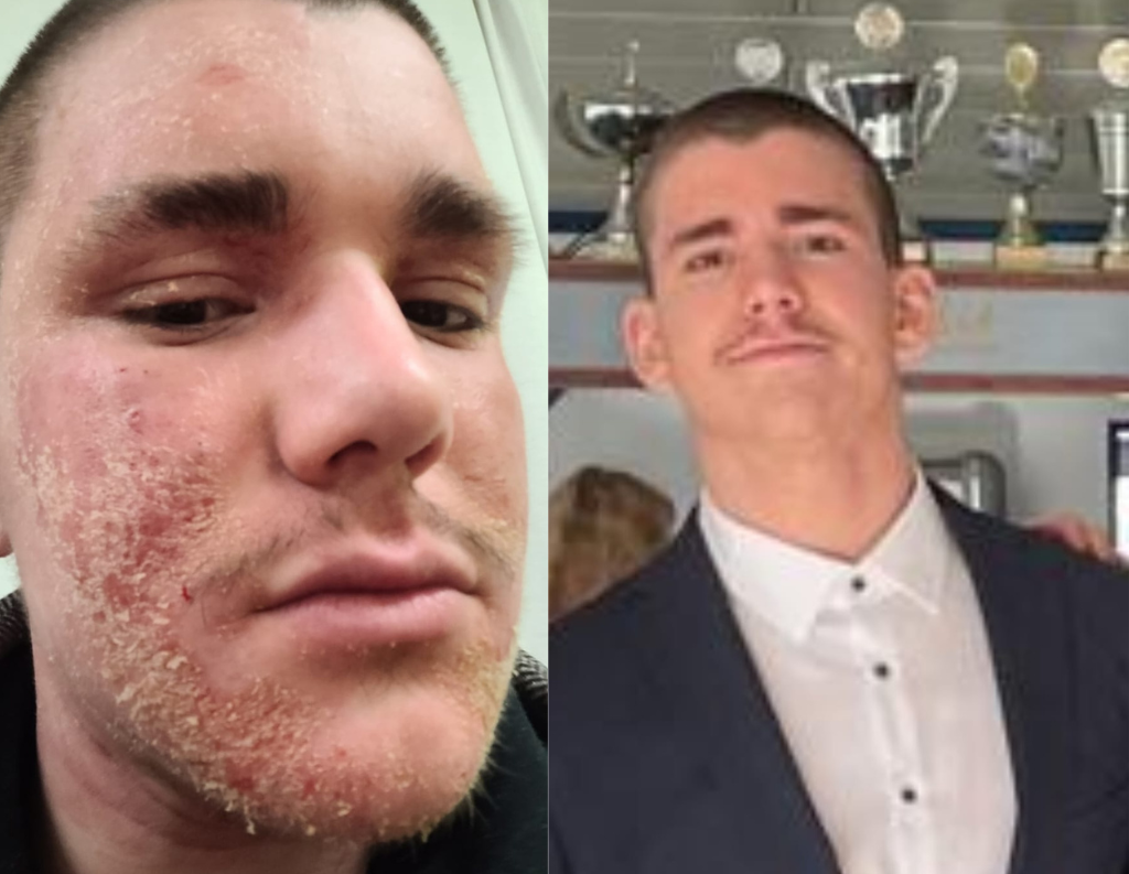 Home Complete healing from eczema